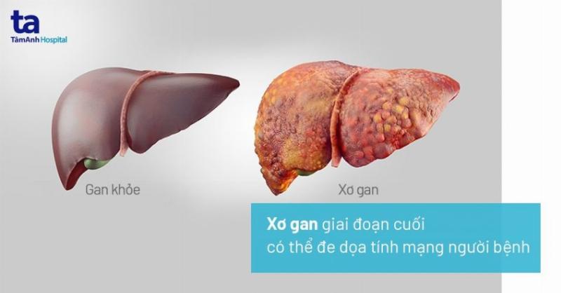 Minh hoa mot so bien chung tiem an sau dieu tri gay xuong cang chan, giup hoan thien benh an